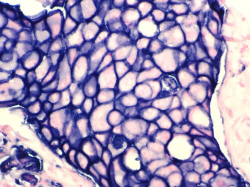HER-2 neu Mmab Antibody Immunohistochemistry on a FFPE Breast Carcinoma Tissue